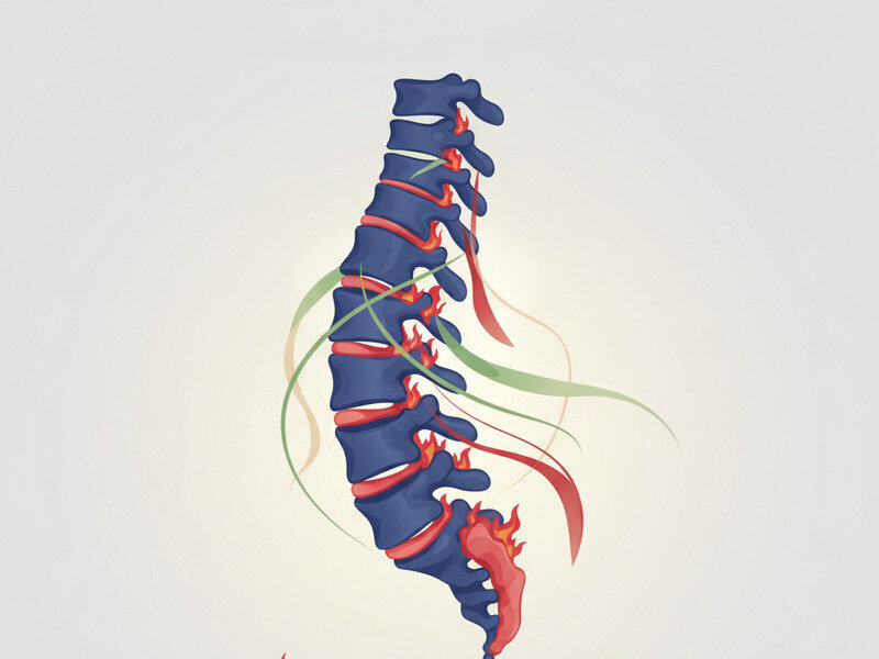 How Much Is Too Much? Avoiding Overexertion with Ankylosing Spondylitis hero image