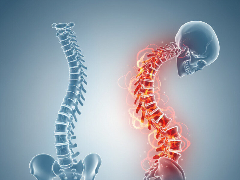 How Poor Posture Triggers Inflammation and Stiffness in AS hero image